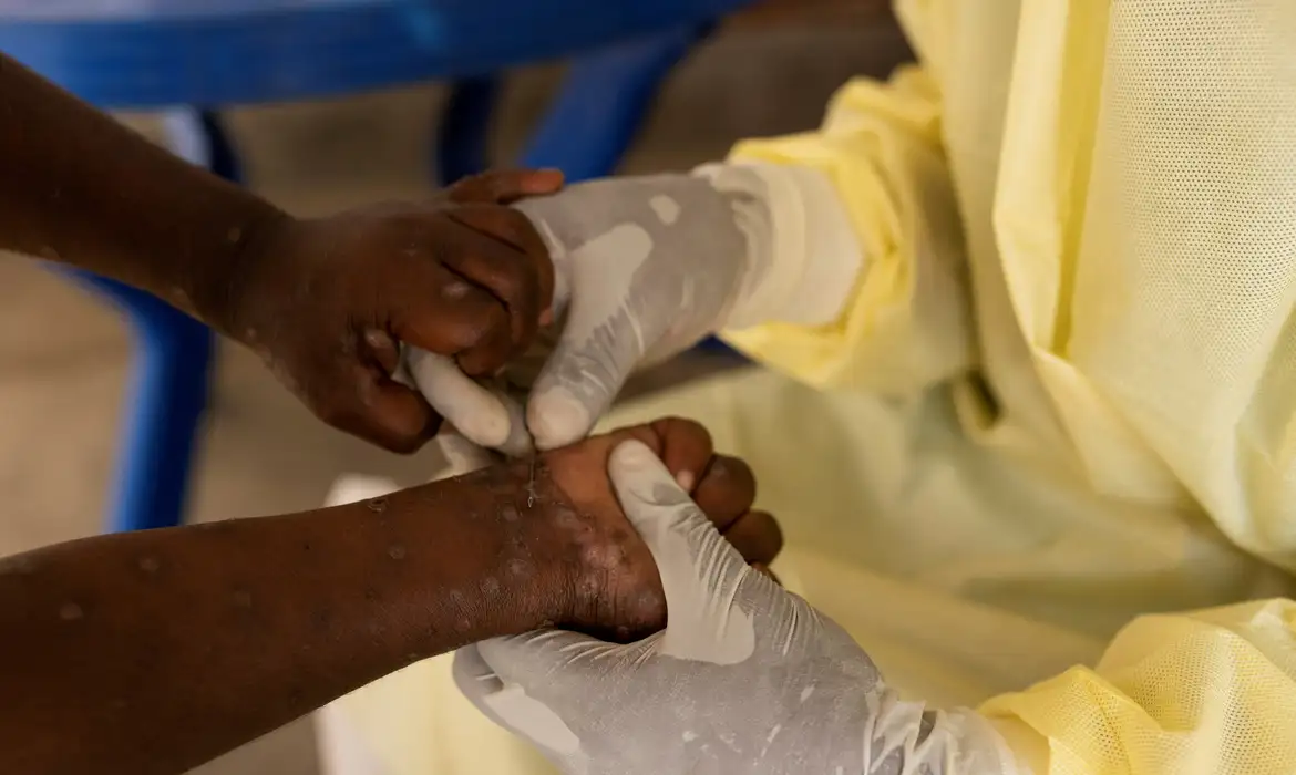 mpox:-saiba-quais-doencas-ja-tiveram-mais-alto-nivel-de-alerta-global-–-folha-de-dourados-–-noticias-de-dourados-ms-e-regiao