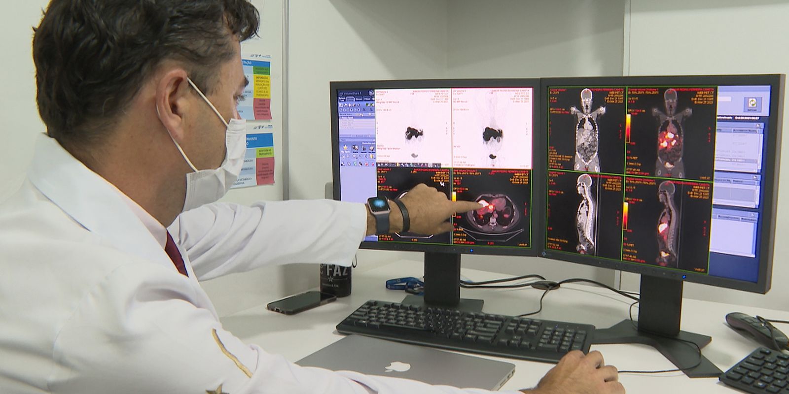 rastreamento-de-cancer-de-intestino-identifica-lesoes-em-231-pacientes