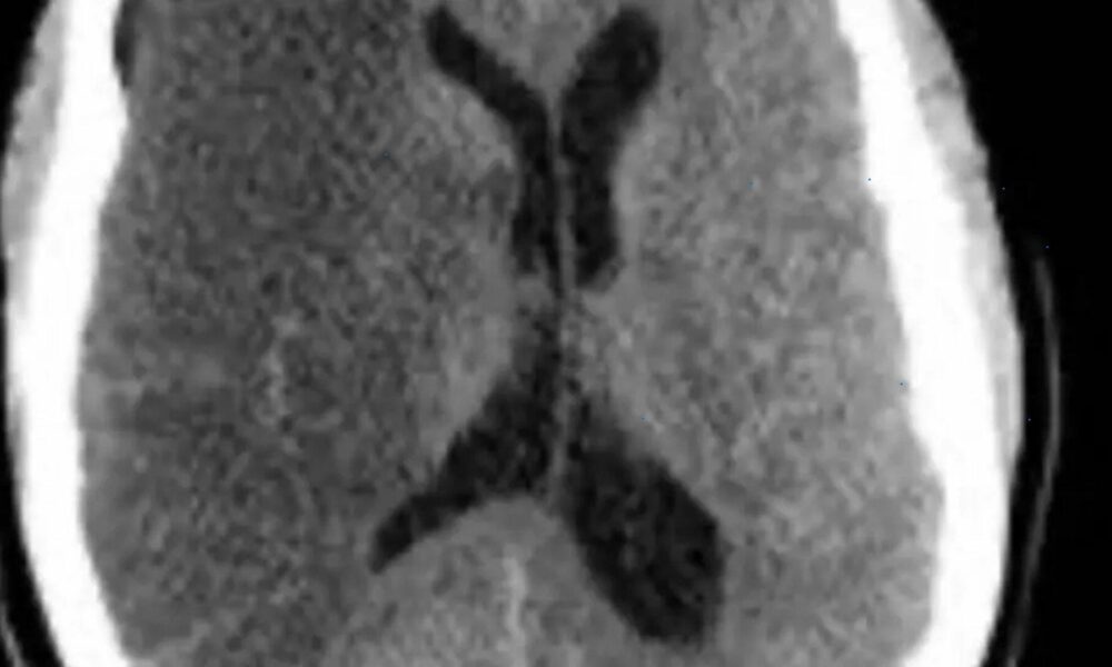 caso-raro:-professora-de-educacao-fisica-sofre-avc-durante-aula-em-academia