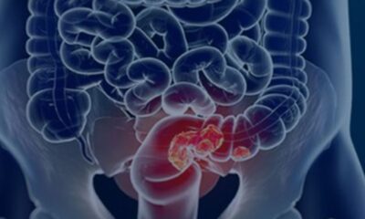 pacientes-com-cancer-colorretal-sao-diagnosticados-em-estagio-avancado